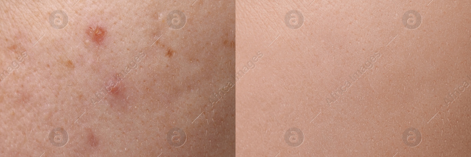 Image of Collage with photos of person suffering from acne before and after treatment, closeup. Banner design showing affected and healthy skin