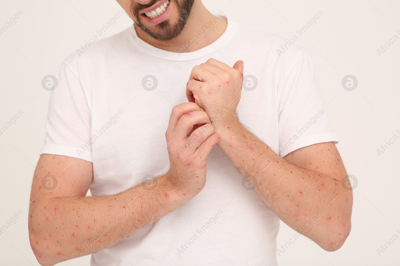 Photo of Man with rash suffering from monkeypox virus on beige background, closeup