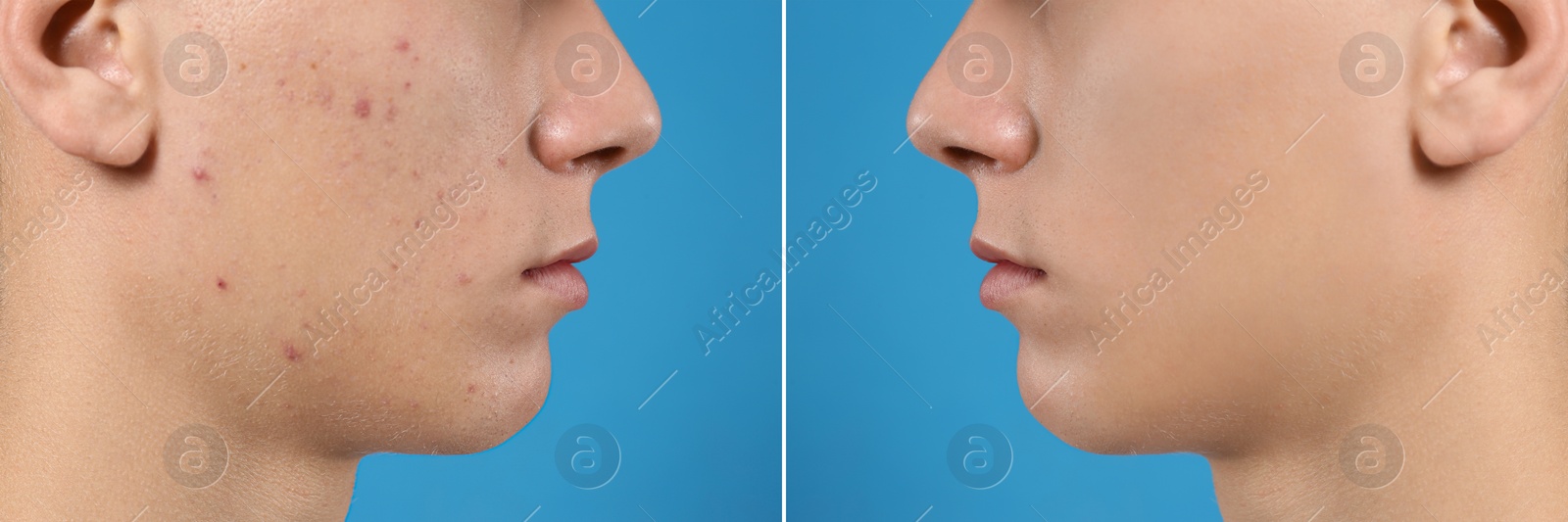 Image of Teenager before and after acne treatment on blue background, closeup 