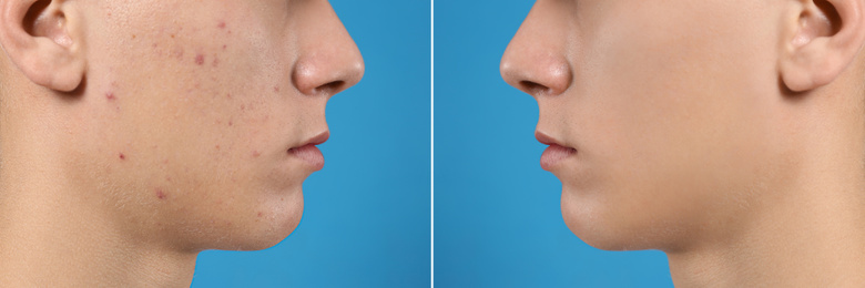 Teenager before and after acne treatment on blue background, closeup 