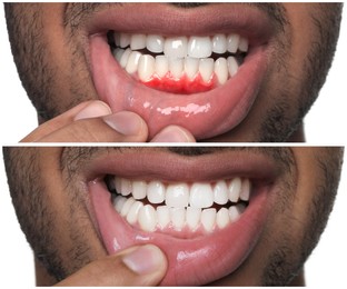 Man showing gum before and after treatment on white background, collage of photos