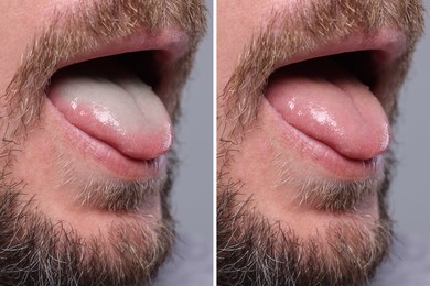 Man showing his tongue before and after cleaning procedure, closeup. Tongue coated with plaque on one side and healthy on other, collage
