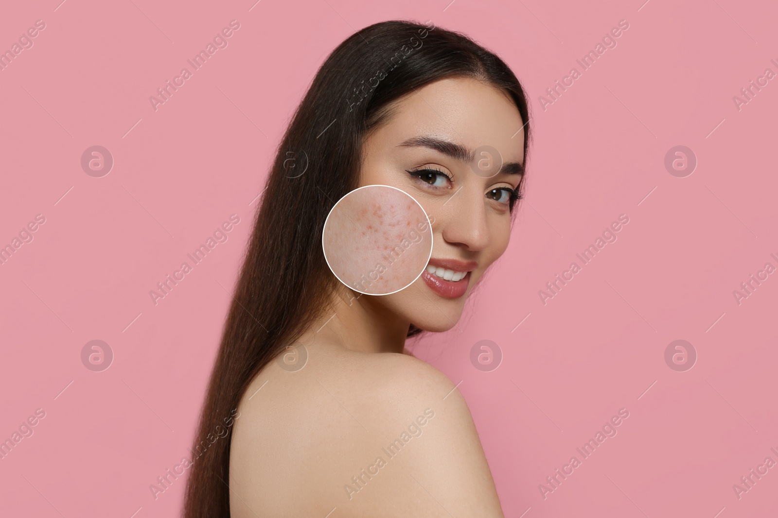 Image of Woman with acne on her face on pink background. Zoomed area showing problem skin