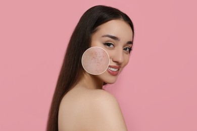 Image of Woman with acne on her face on pink background. Zoomed area showing problem skin