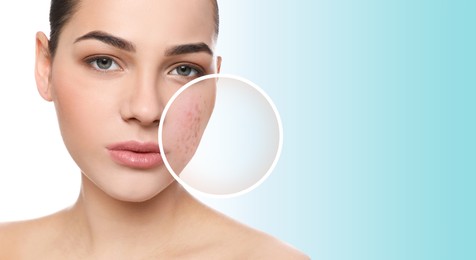 Woman with acne on her face on light blue gradient background, banner design. Zoomed area showing problem skin