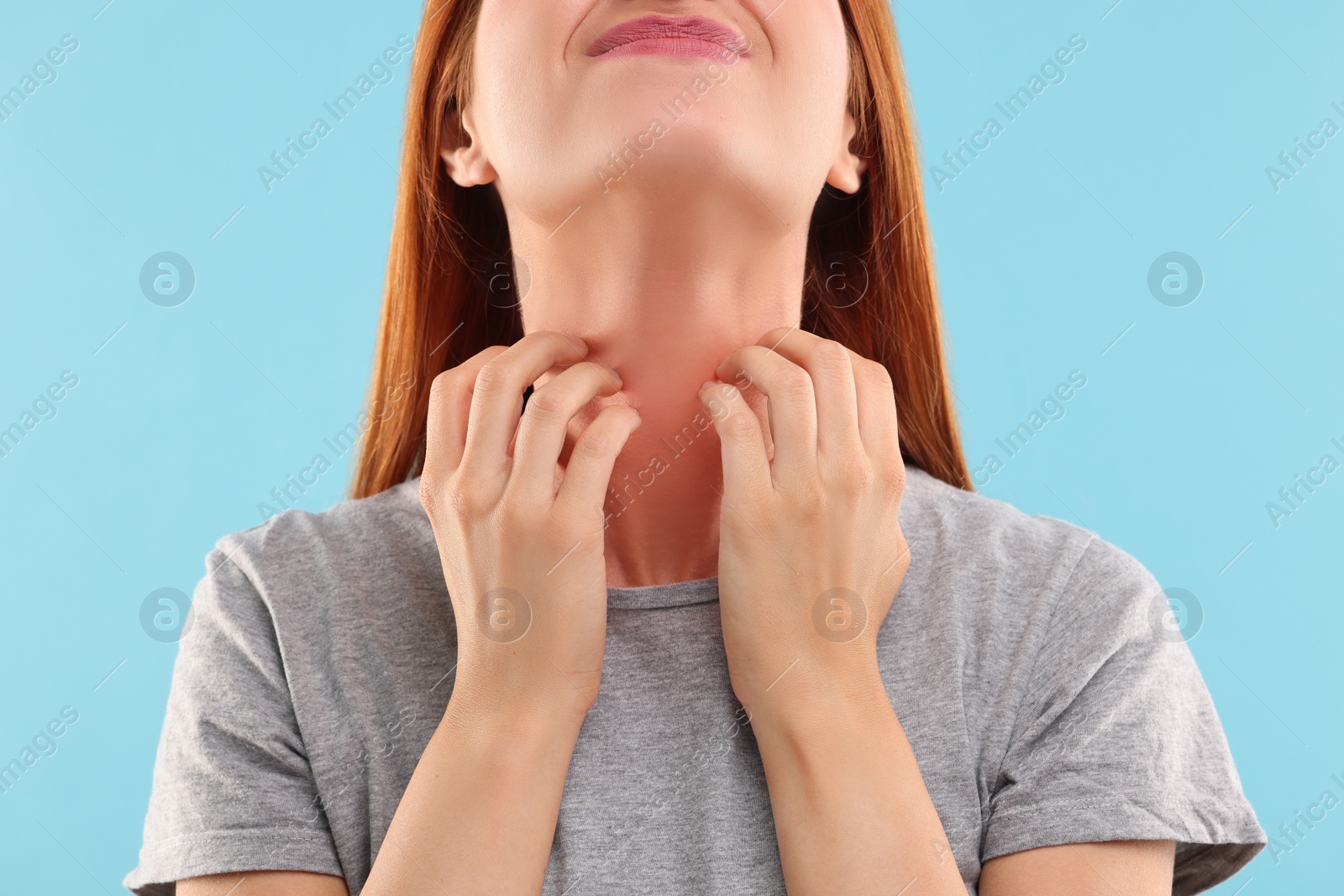 Photo of Suffering from allergy. Young woman scratching her neck on light blue background, closeup