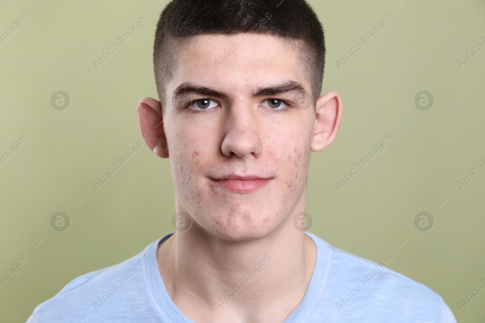 Photo of Young man with acne problem on olive background