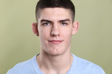 Photo of Young man with acne problem on olive background