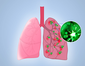 Illustration of  human lungs affected with disease on light blue background