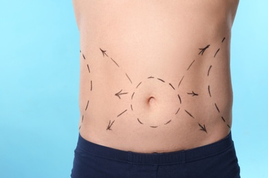 Photo of Man with marks on belly for cosmetic surgery operation against blue background, closeup