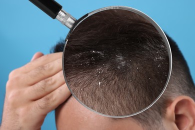 Man suffering from dandruff on light blue background, closeup. View through magnifying glass on hair with flakes