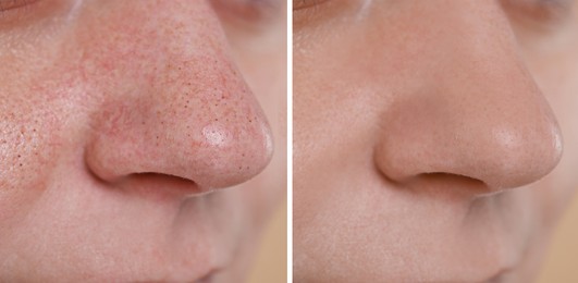 Image of Blackhead treatment, before and after. Collage with photos of woman, closeup view