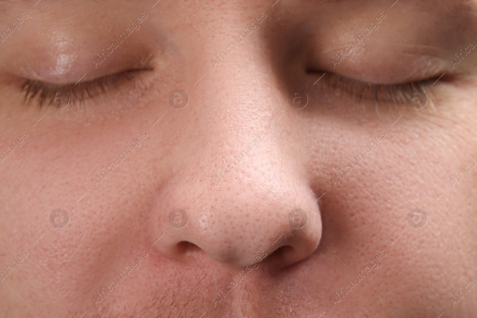 Photo of Young man with acne problem, closeup view of nose