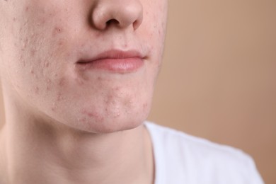 Young man with acne problem on beige background, closeup