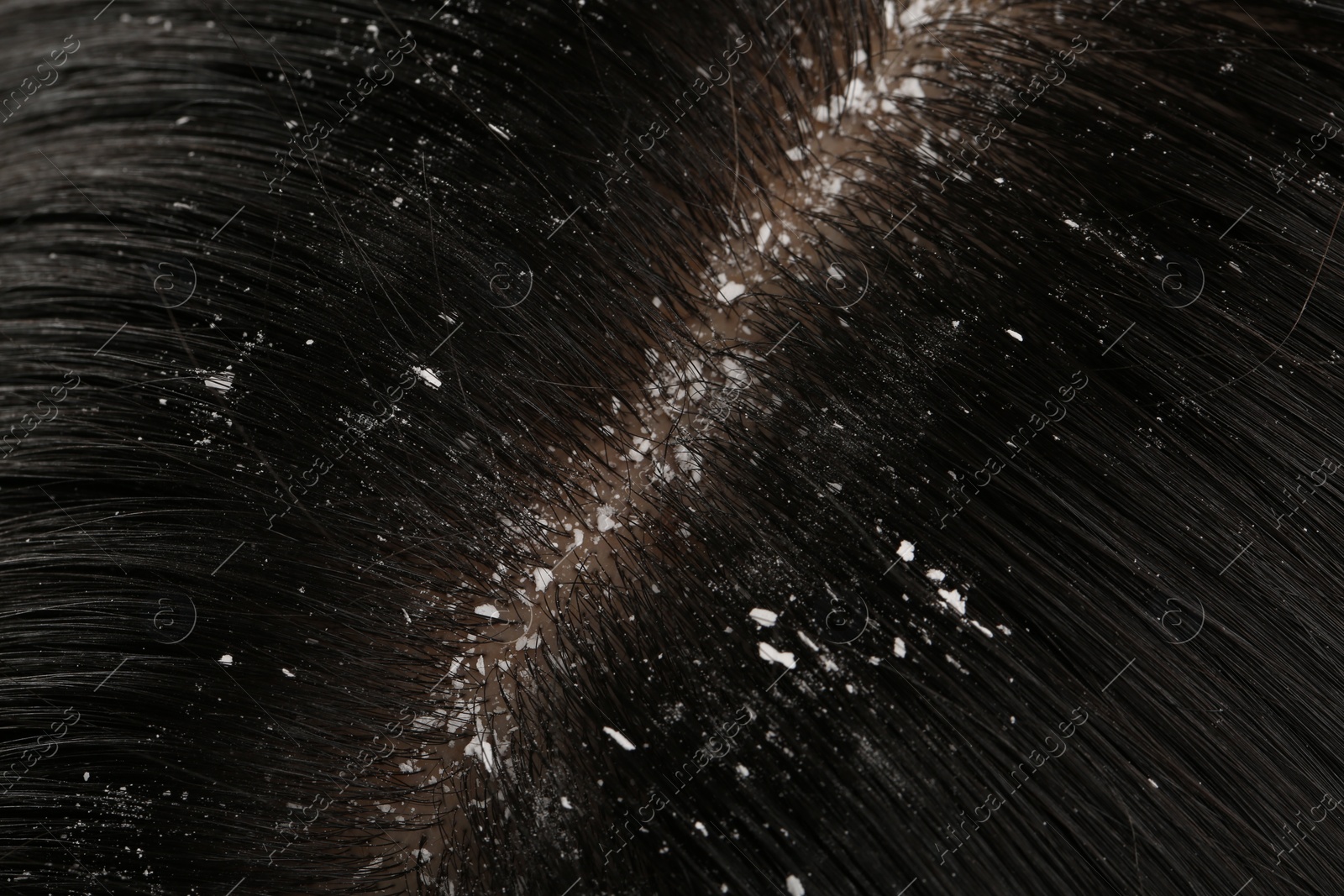 Photo of Woman with dandruff in her dark hair, closeup view