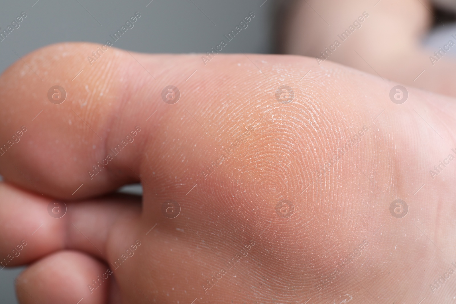 Photo of Woman with dry skin on foot, closeup