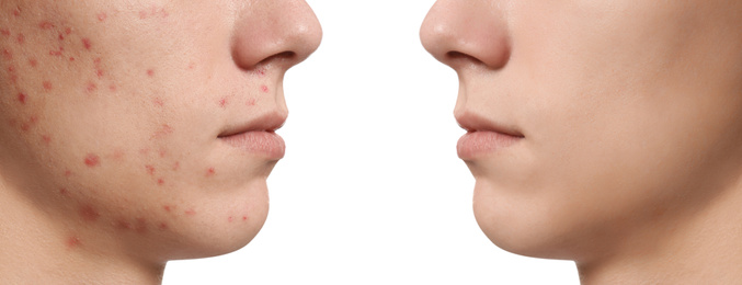 Image of Teenager before and after acne treatment on white background, closeup 