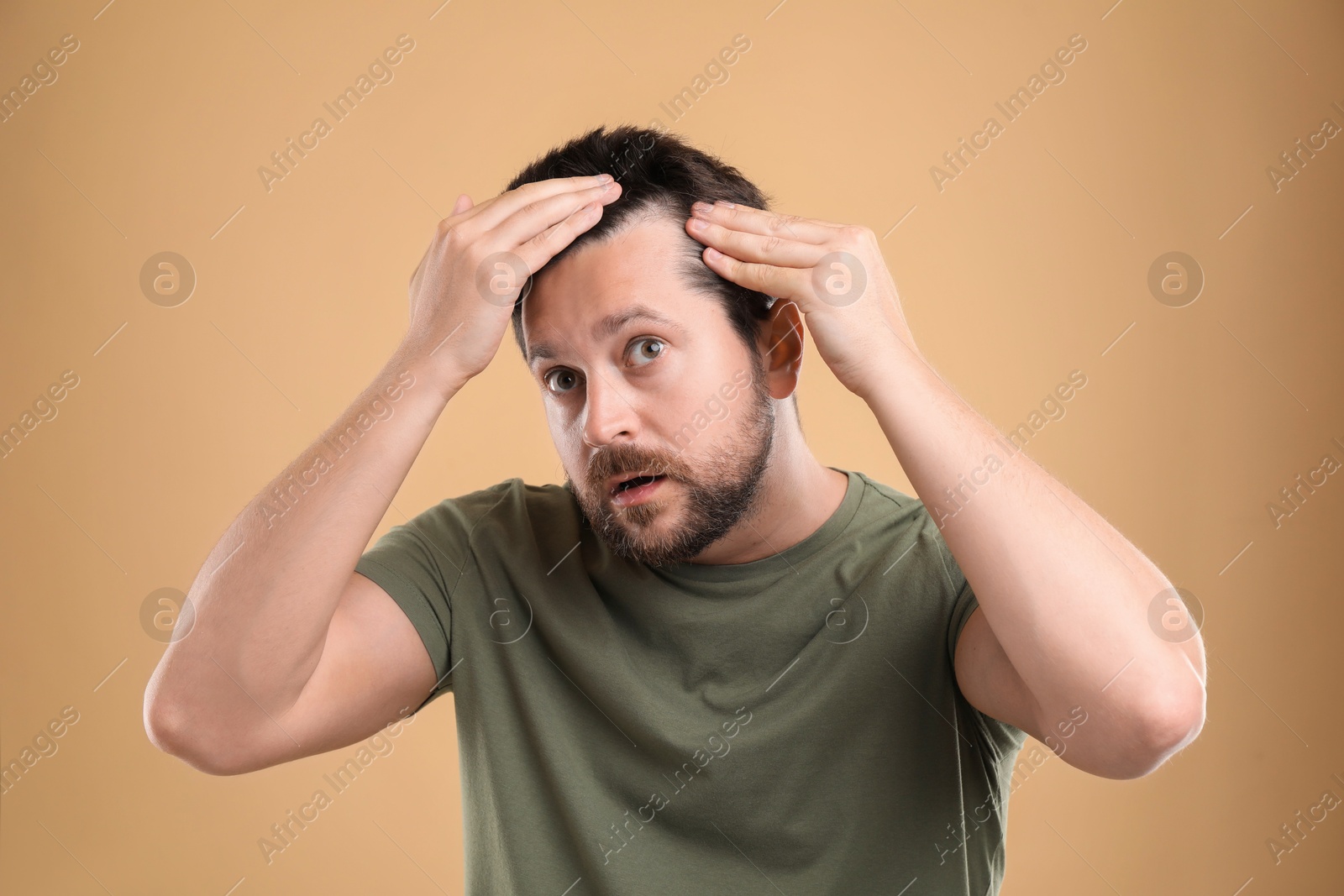 Photo of Man with hair loss problem on beige background