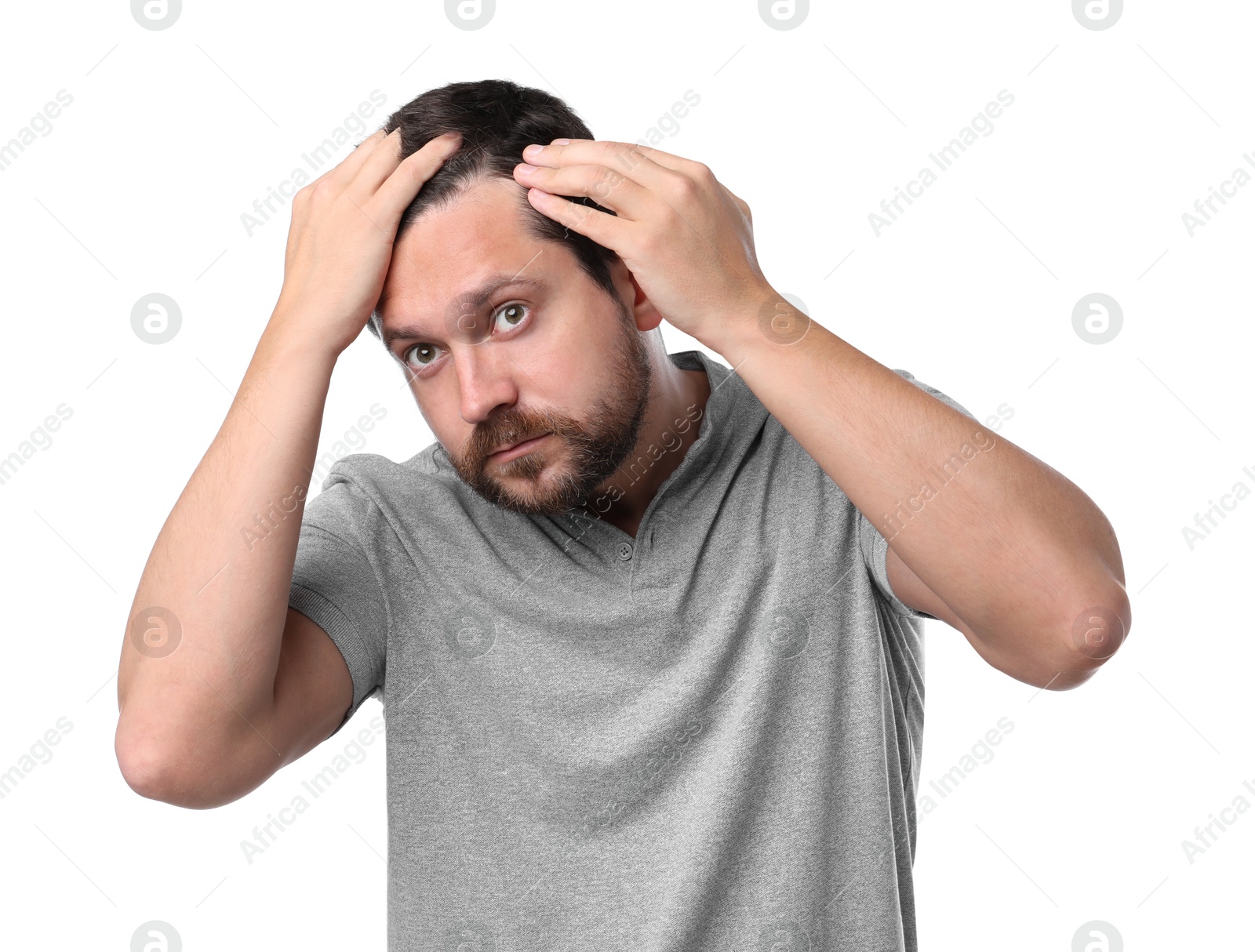 Photo of Man with hair loss problem on white background