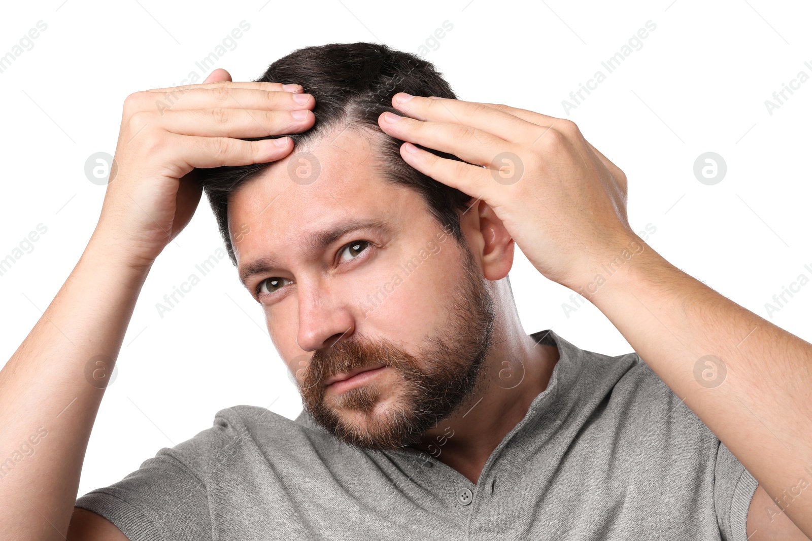 Photo of Man with hair loss problem on white background