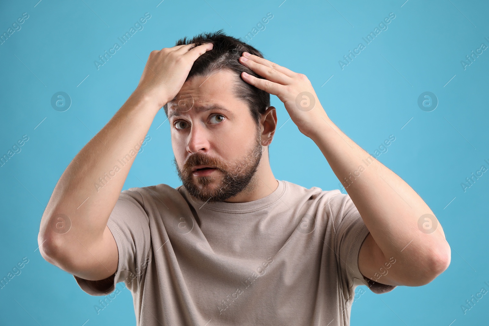 Photo of Man with hair loss problem on light blue background