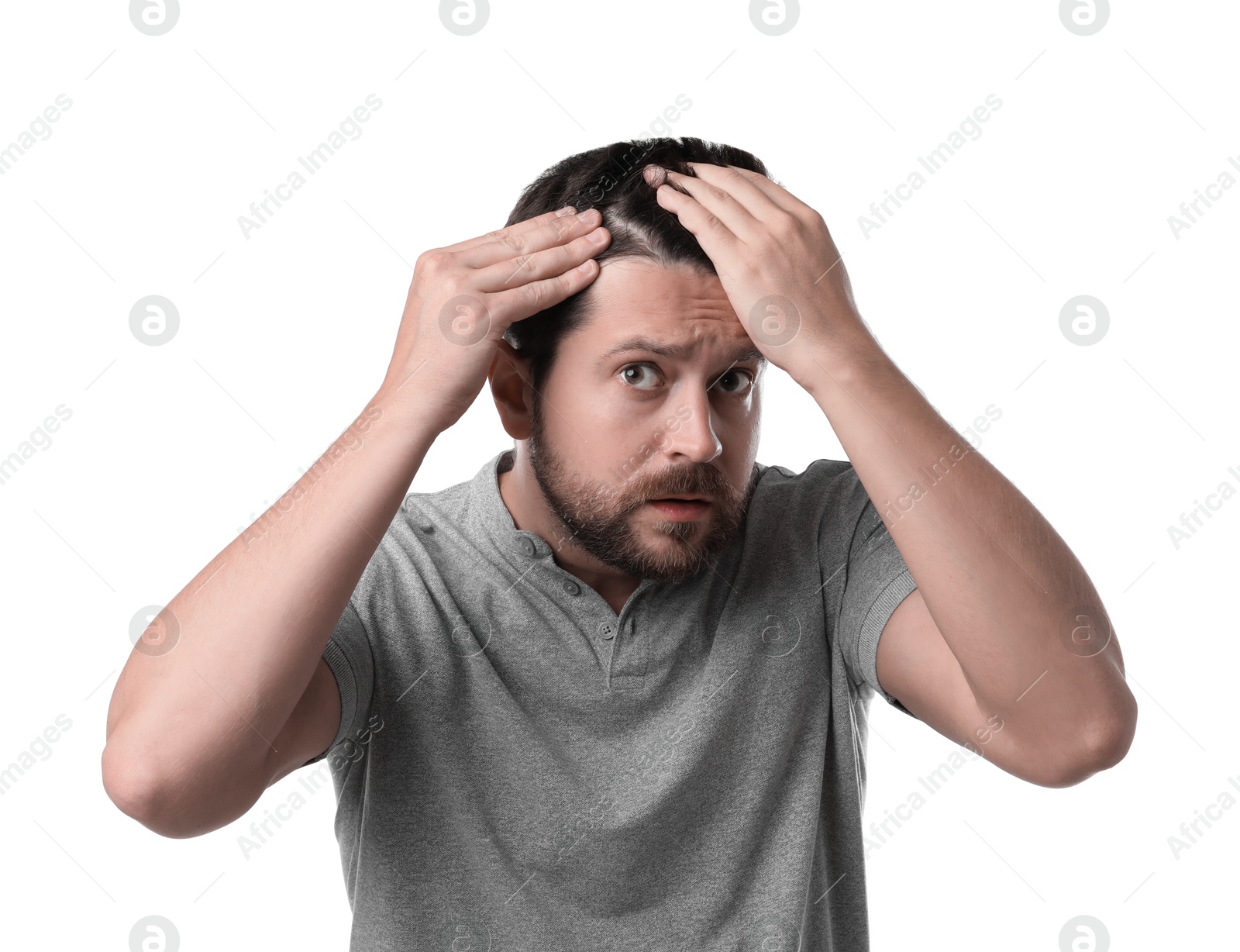 Photo of Man with hair loss problem on white background