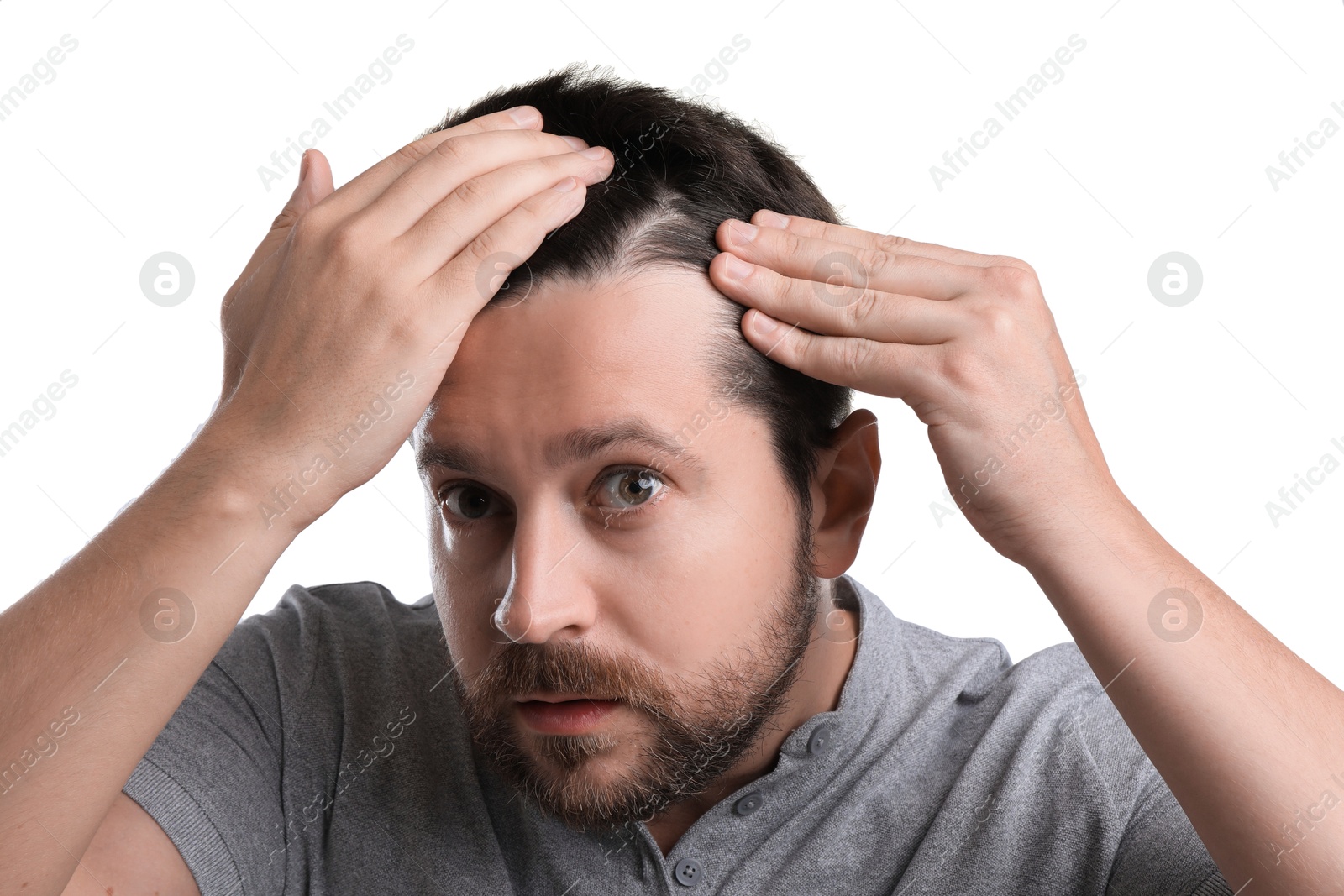 Photo of Man with hair loss problem on white background