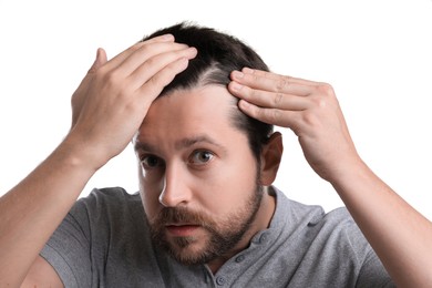 Man with hair loss problem on white background