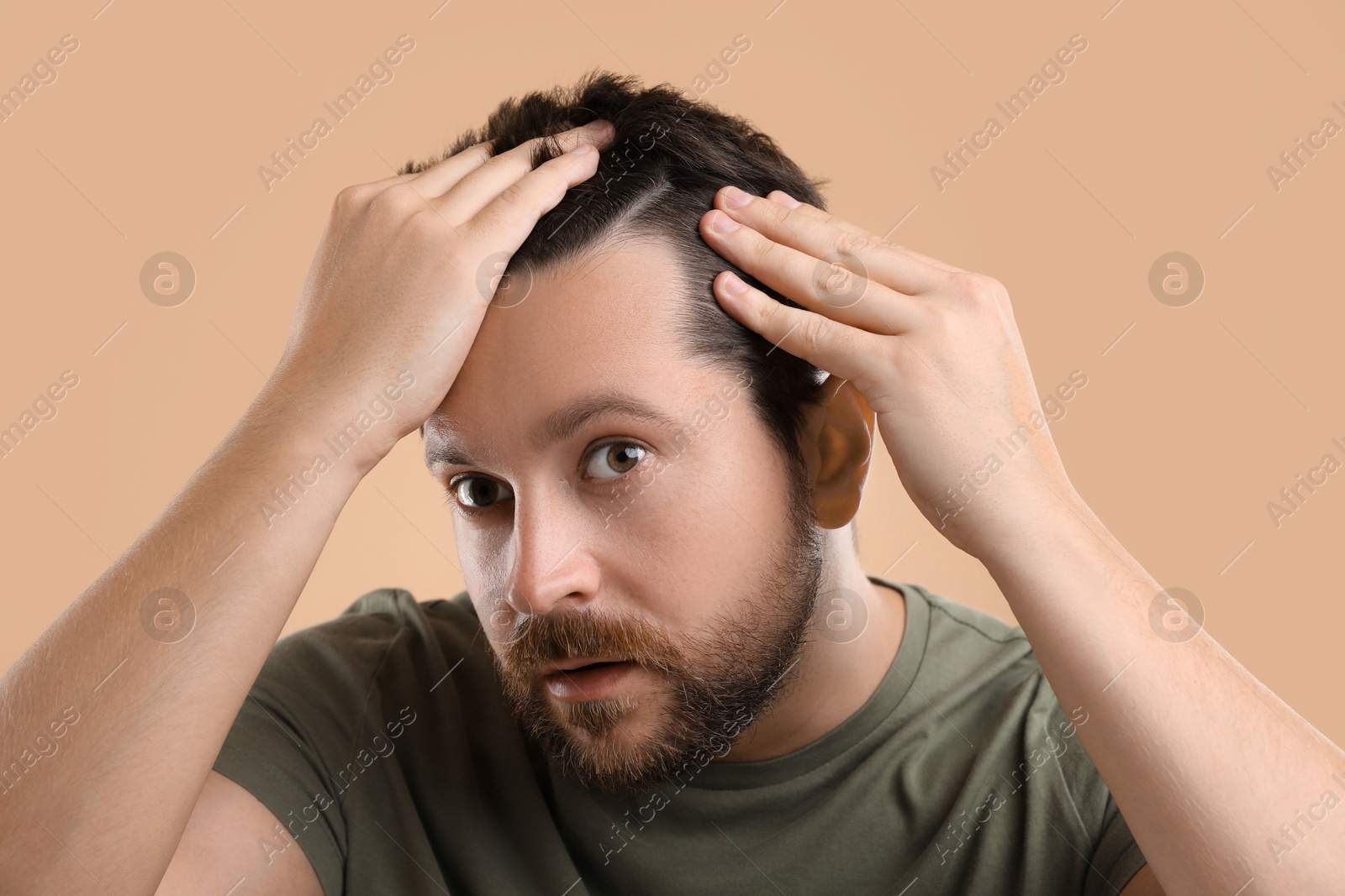 Photo of Man with hair loss problem on beige background