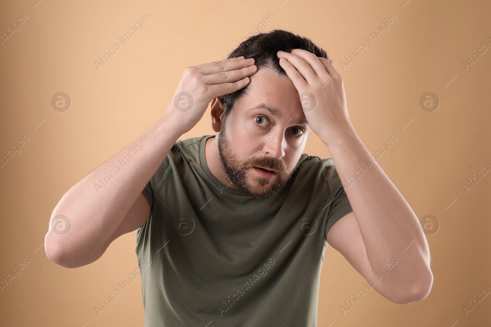 Photo of Man with hair loss problem on beige background