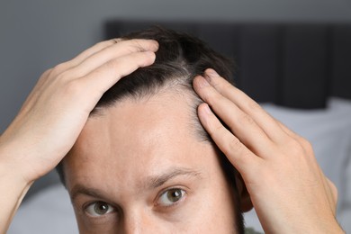 Photo of Man with hair loss problem indoors, closeup