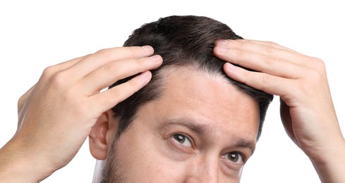 Man with hair loss problem on white background