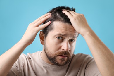 Man with hair loss problem on light blue background