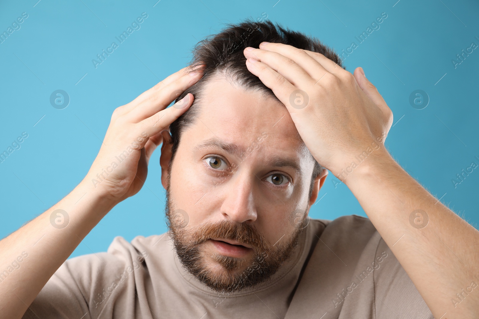 Photo of Man with hair loss problem on light blue background