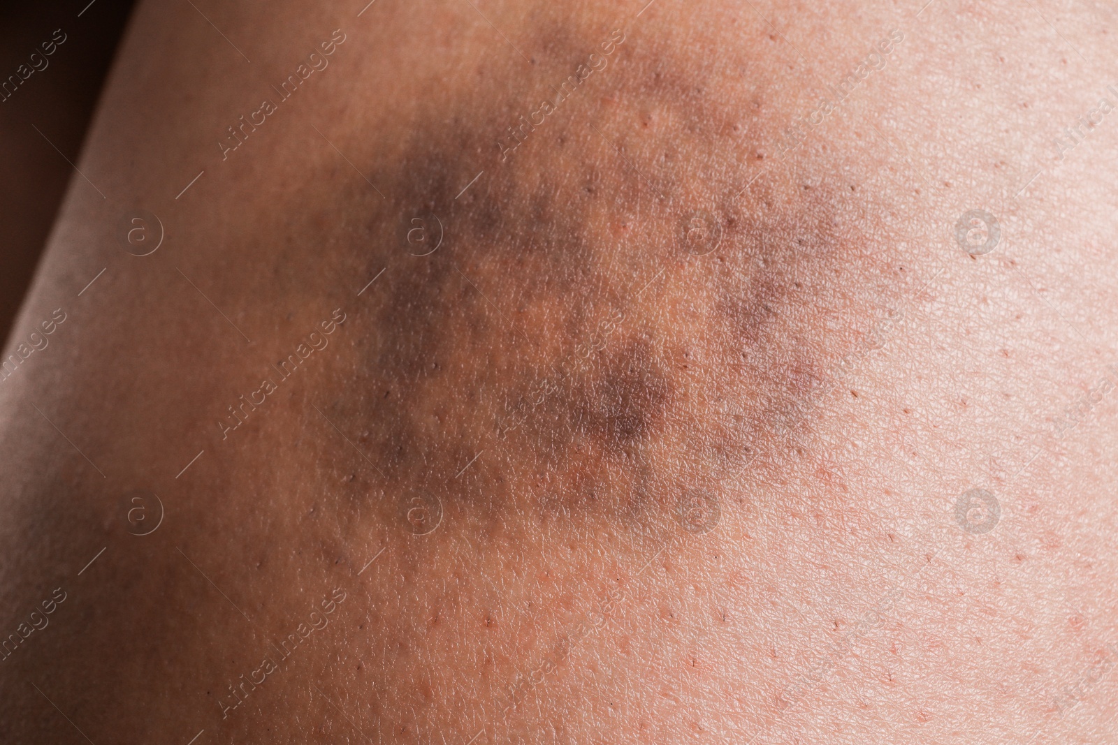 Photo of Closeup view of woman with bruise on leg