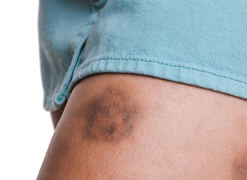 Photo of Woman with bruise on leg against white background, closeup