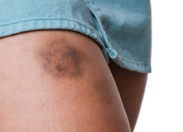 Photo of Woman with bruise on leg against white background, closeup