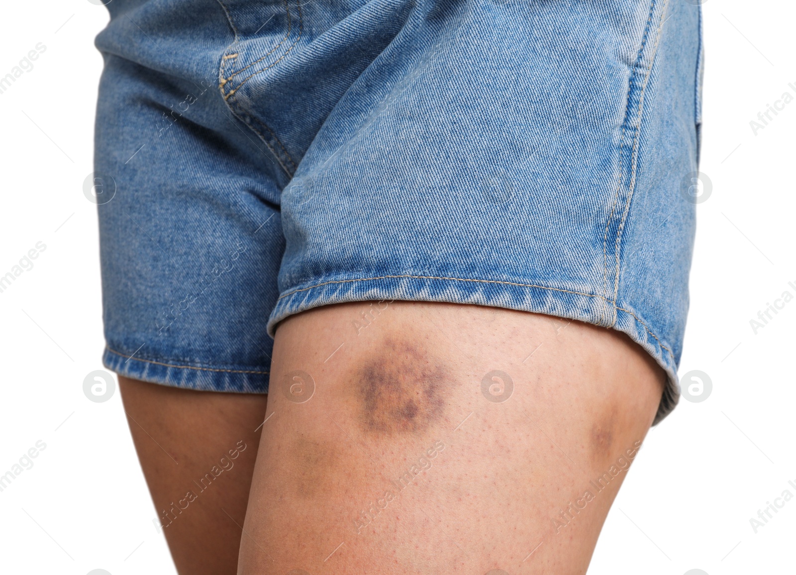 Photo of Woman with bruise on leg against white background, closeup