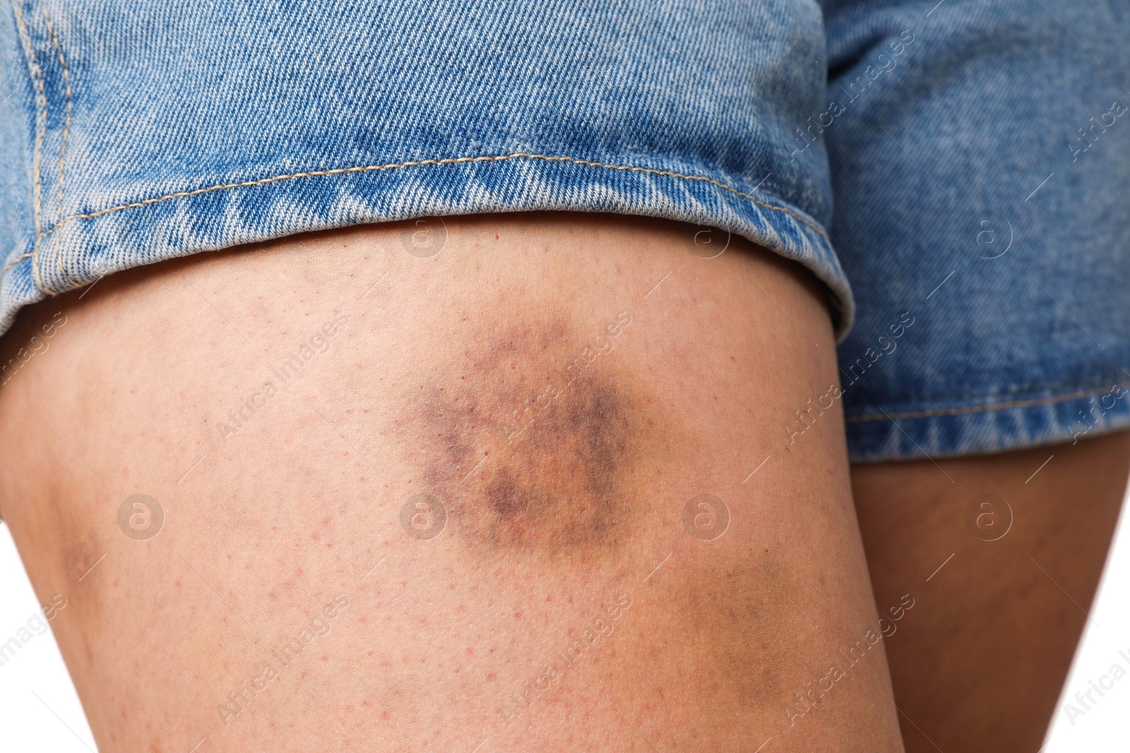 Photo of Woman with bruise on leg against white background, closeup