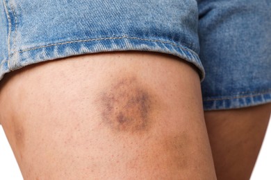 Photo of Woman with bruise on leg against white background, closeup