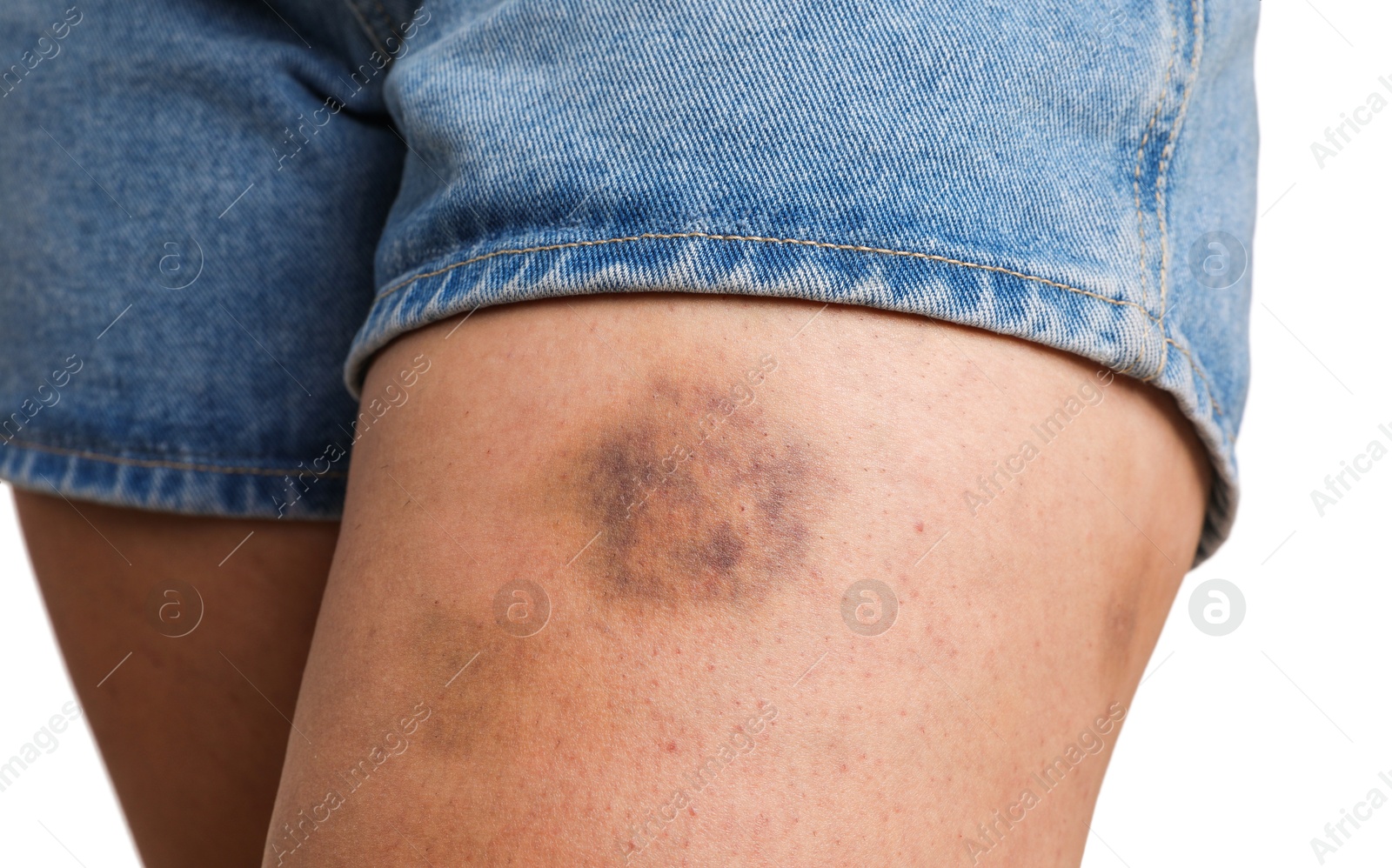 Photo of Woman with bruise on leg against white background, closeup