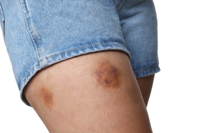 Photo of Woman with bruise on leg against white background, closeup