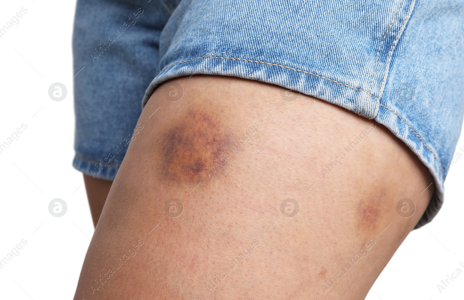 Photo of Woman with bruise on leg against white background, closeup