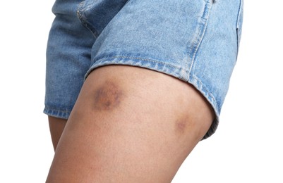 Photo of Woman with bruise on leg against white background, closeup