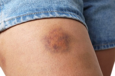 Photo of Woman with bruise on leg against white background, closeup