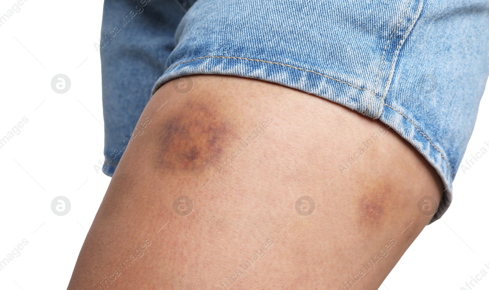 Photo of Woman with bruise on leg against white background, closeup