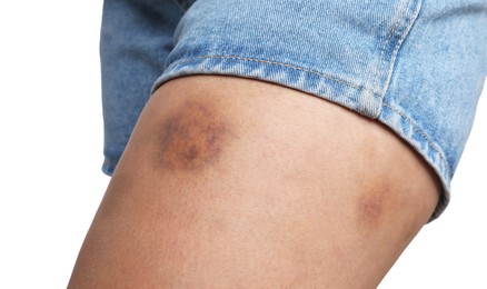 Photo of Woman with bruise on leg against white background, closeup