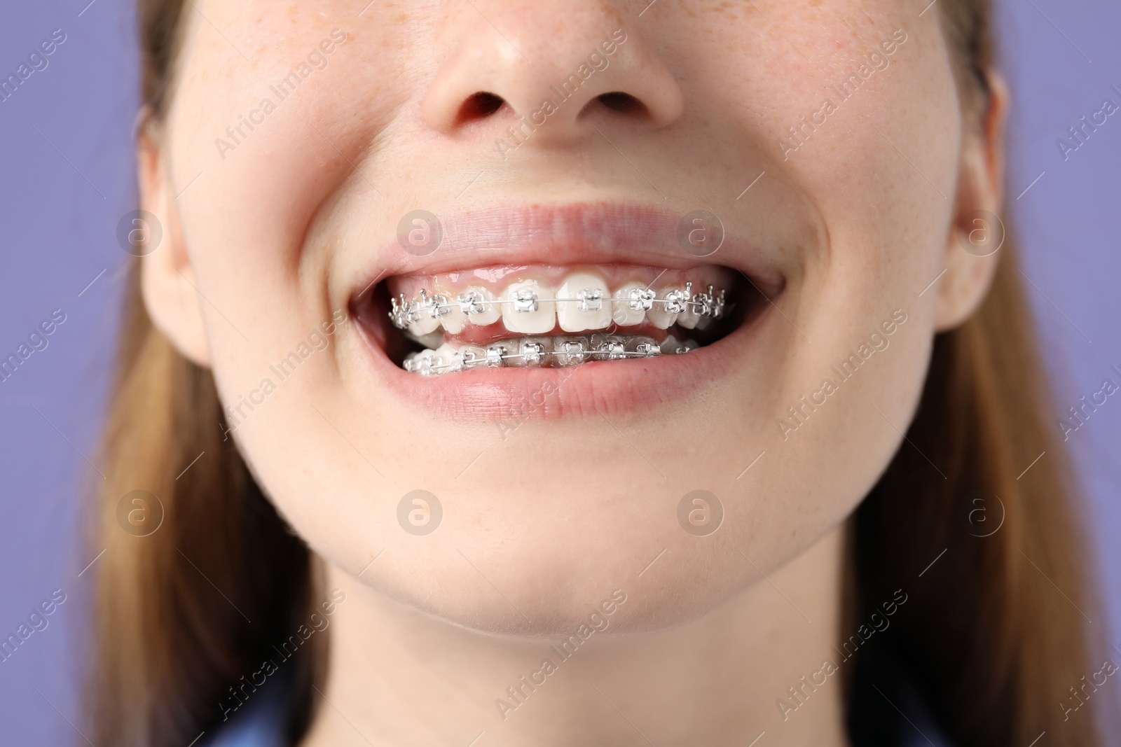 Photo of Girl with braces on purple background, closeup