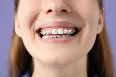 Photo of Girl with braces on purple background, closeup