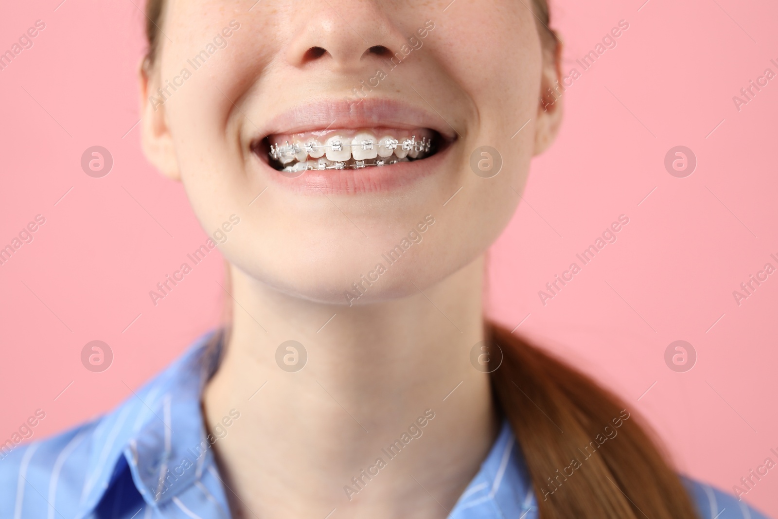 Photo of Girl with braces on pink background, closeup